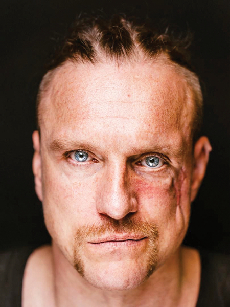 Kara rētas uz Andrija Kiceļuka sejas