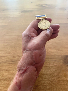 Medaļa Kara veterāns smagi sakropļotajā rokā