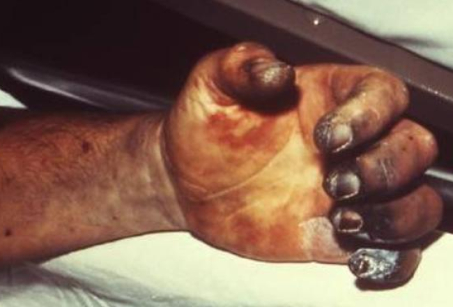 Foto: rarediseases.about.com