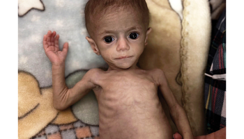 Sešus mēnešus vecā palestīniešu meitenīte Sivara Ašura cieš no pārtikas trūkuma.