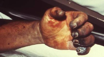 Foto: rarediseases.about.com