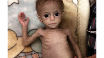 Sešus mēnešus vecā palestīniešu meitenīte Sivara Ašura cieš no pārtikas trūkuma.