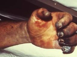 Foto: rarediseases.about.com